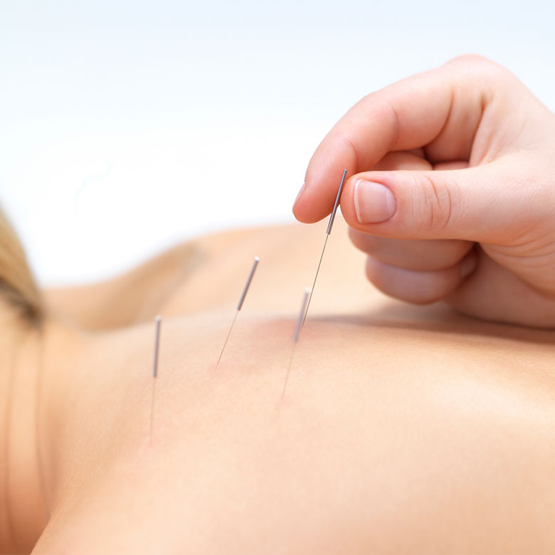 Acupuncture tile- close up of acupuncturist placing needles carefully into the patients skin